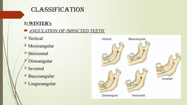 IMPACTION - Oral Surgery by Dr. Kenil Tarpara.pptx