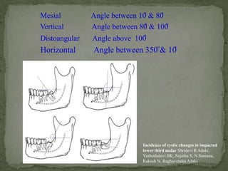 management of impacted teeth | PPTX