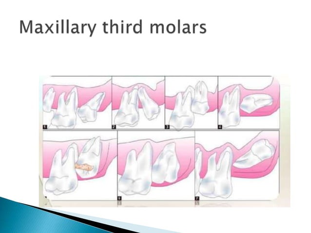IMPACTION IN ORAL SURGERY UPDATED.pptx