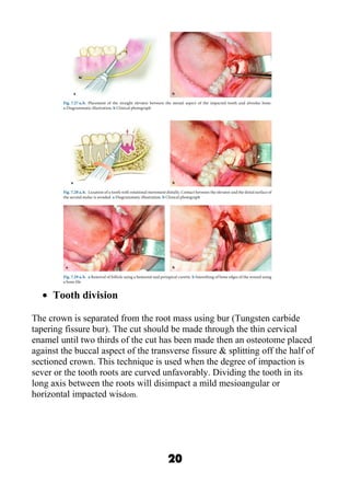 Impaction l1 | DOC
