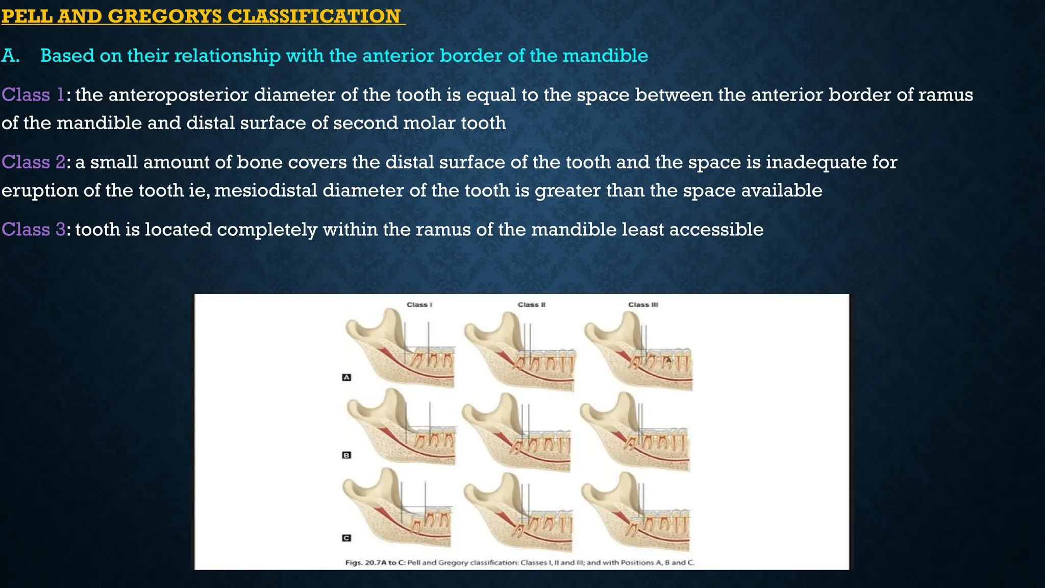 PELL AND GREGORYS CLASSIFICATION
A. Based on their relationship with the anterior border of the mandible
Class 1: the anteroposterior diameter of the tooth is equal to the space between the anterior border of ramus
of the mandible and distal surface of second molar tooth
Class 2: a small amount of bone covers the distal surface of the tooth and the space is inadequate for
eruption of the tooth ie, mesiodistal diameter of the tooth is greater than the space available
Class 3: tooth is located completely within the ramus of the mandible least accessible
 