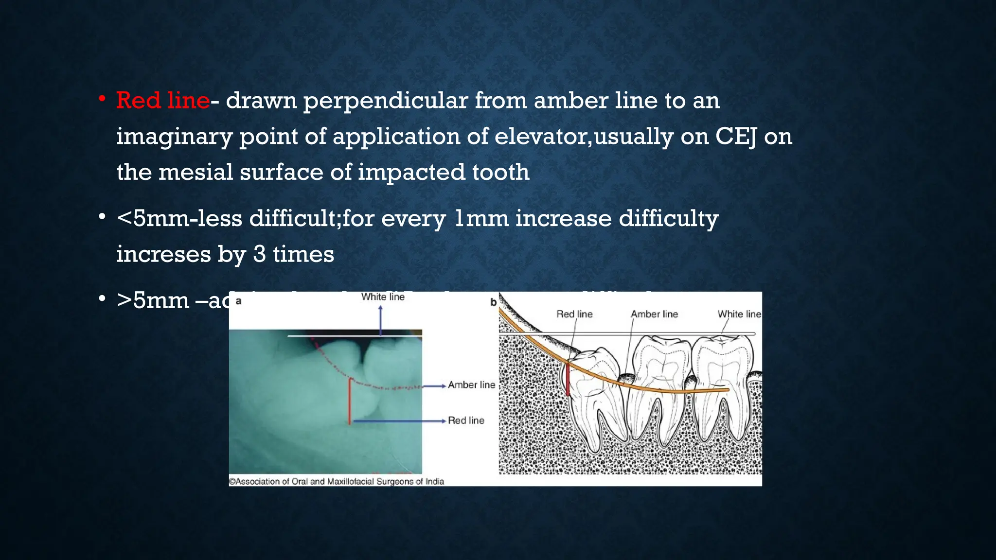 • Red line- drawn perpendicular from amber line to an
imaginary point of application of elevator,usually on CEJ on
the mesial surface of impacted tooth
• <5mm-less difficult;for every 1mm increase difficulty
increses by 3 times
• >5mm –advised under GA;>9mm –very difficult
 