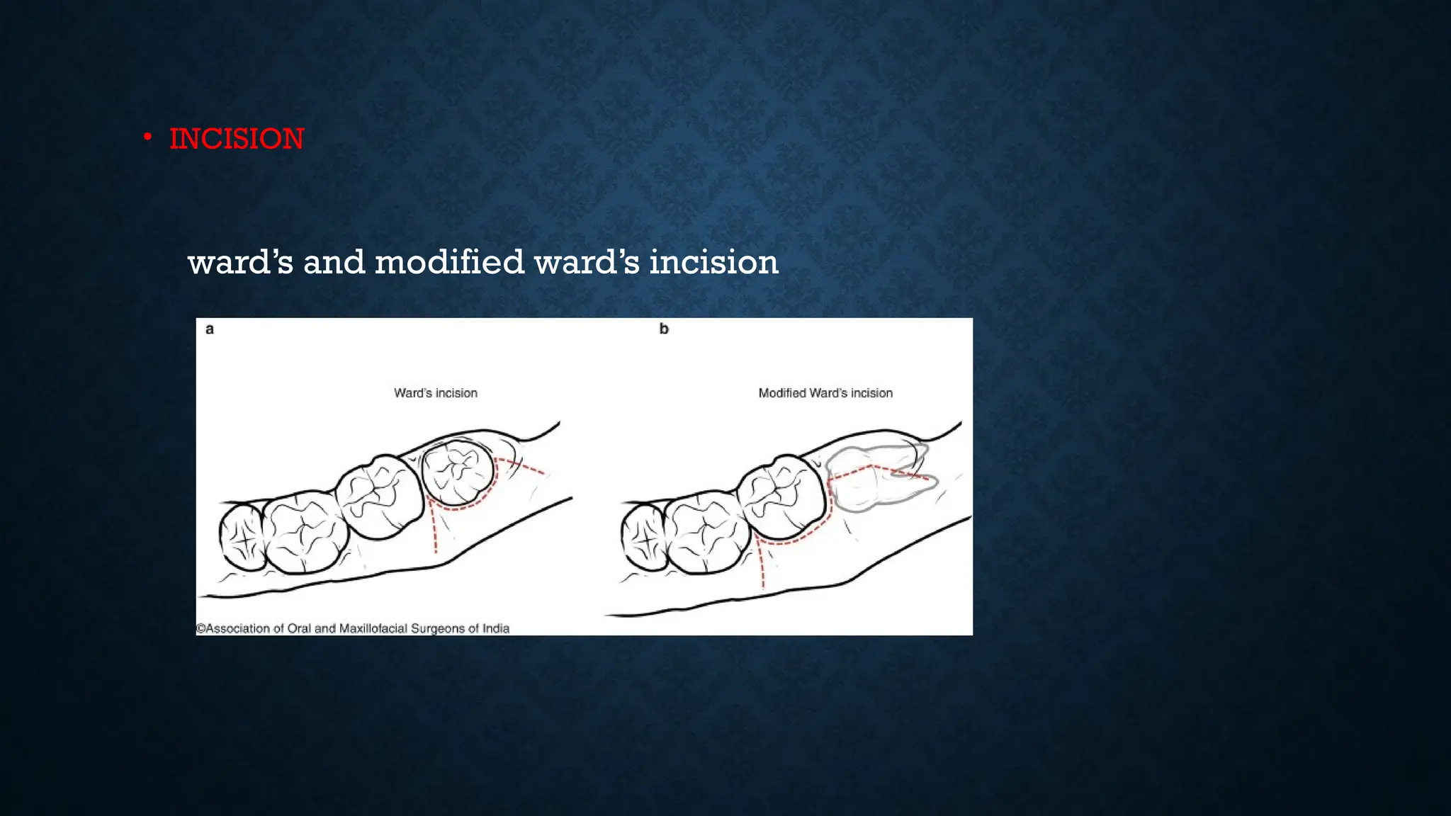 • INCISION
ward’s and modified ward’s incision
 