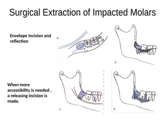 impaction their types and their different form of treatment and ...