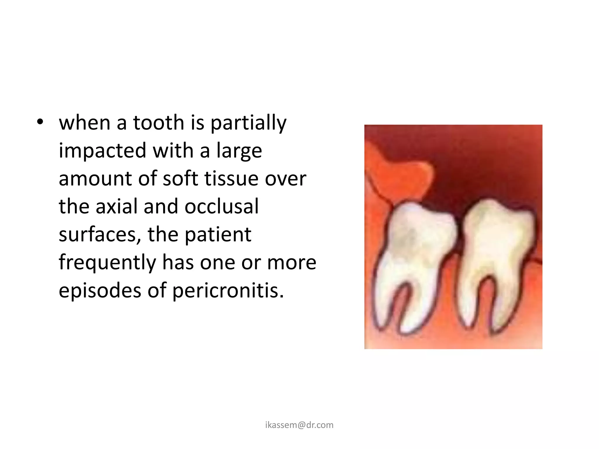 • when a tooth is partially
  impacted with a large
  amount of soft tissue over
  the axial and occlusal
  surfaces, the patient
  frequently has one or more
  episodes of pericronitis.




                      ikassem@dr.com
 