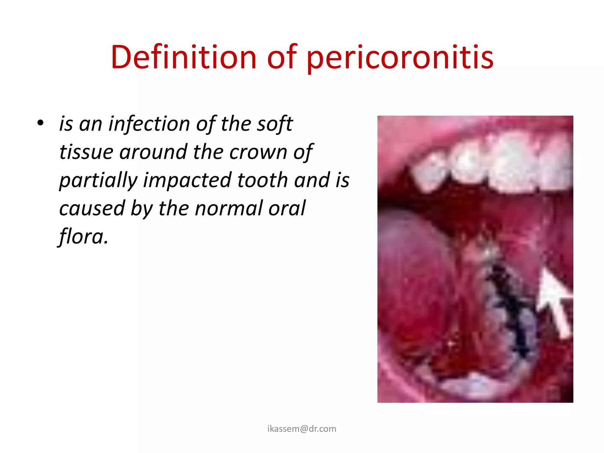 Definition of pericoronitis
• is an infection of the soft
  tissue around the crown of
  partially impacted tooth and is
  caused by the normal oral
  flora.




                        ikassem@dr.com
 