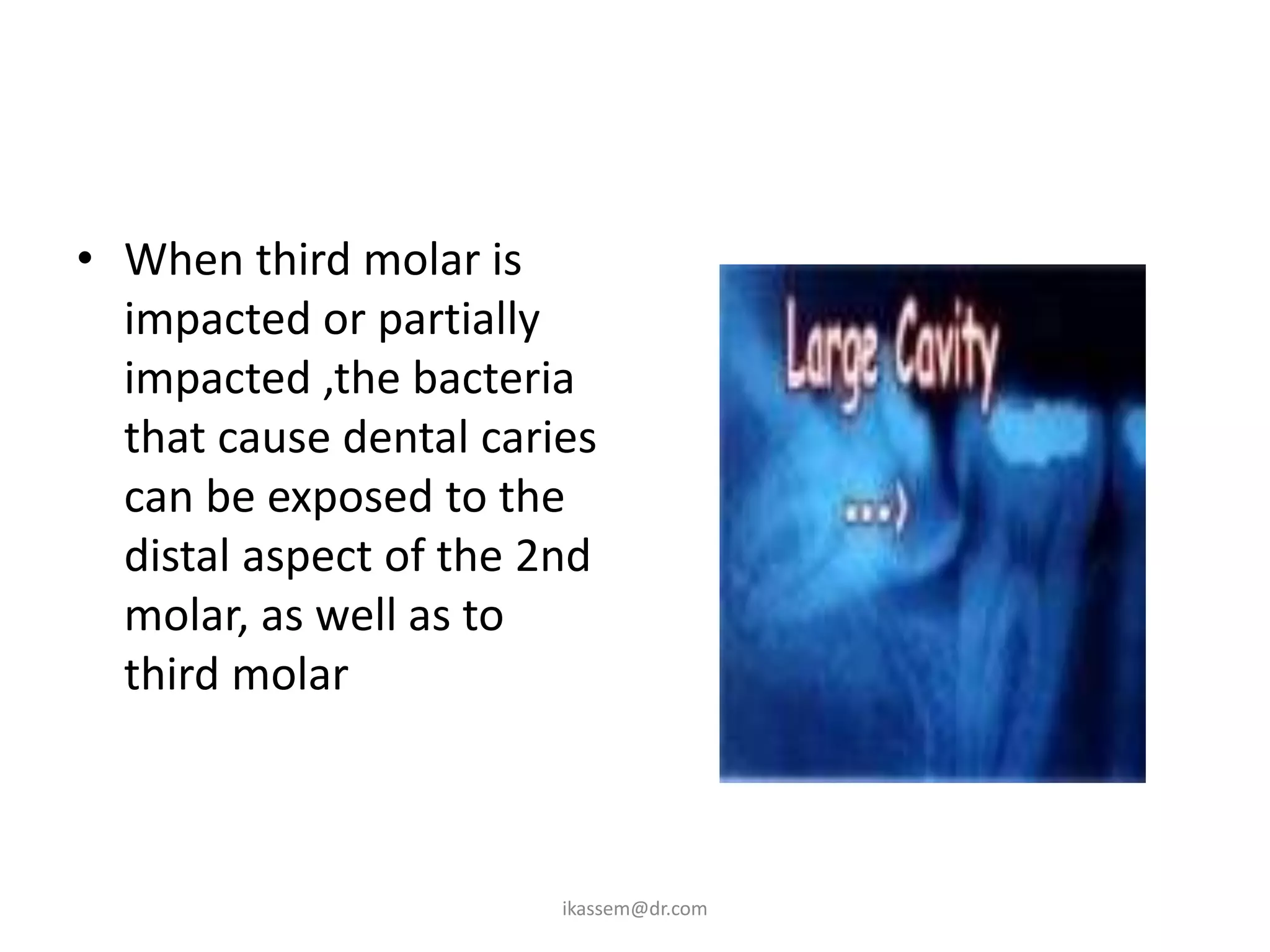 B. Dental Caries
• When third molar is
  impacted or partially
  impacted ,the bacteria
  that cause dental caries
  can be exposed to the
  distal aspect of the 2nd
  molar, as well as to
  third molar



                        ikassem@dr.com
 