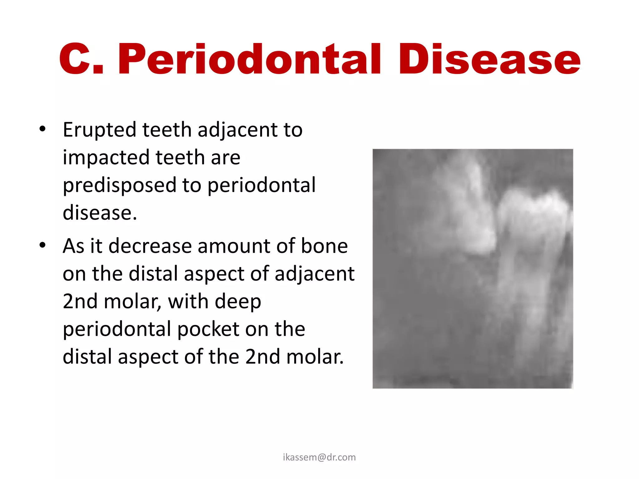 C. Periodontal Disease
• Erupted teeth adjacent to
  impacted teeth are
  predisposed to periodontal
  disease.
• As it decrease amount of bone
  on the distal aspect of adjacent
  2nd molar, with deep
  periodontal pocket on the
  distal aspect of the 2nd molar.



                          ikassem@dr.com
 