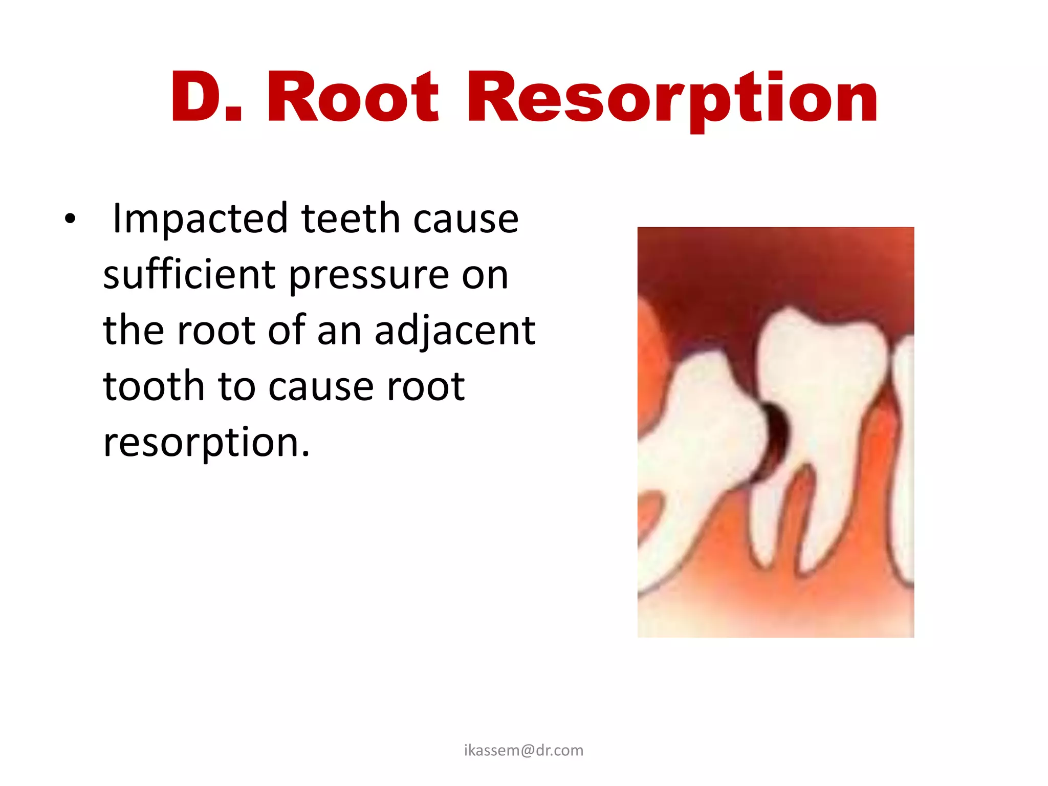 D. Root Resorption
• Impacted teeth cause
 sufficient pressure on
 the root of an adjacent
 tooth to cause root
 resorption.




                    ikassem@dr.com
 