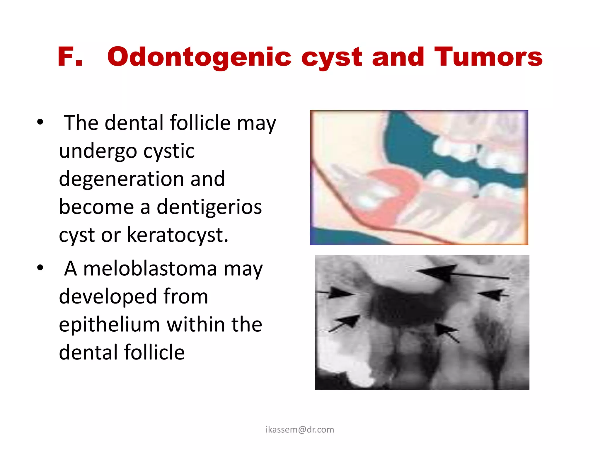 F. Odontogenic cyst and Tumors

• The dental follicle may
  undergo cystic
  degeneration and
  become a dentigerios
  cyst or keratocyst.
• A meloblastoma may
  developed from
  epithelium within the
  dental follicle


                       ikassem@dr.com
 