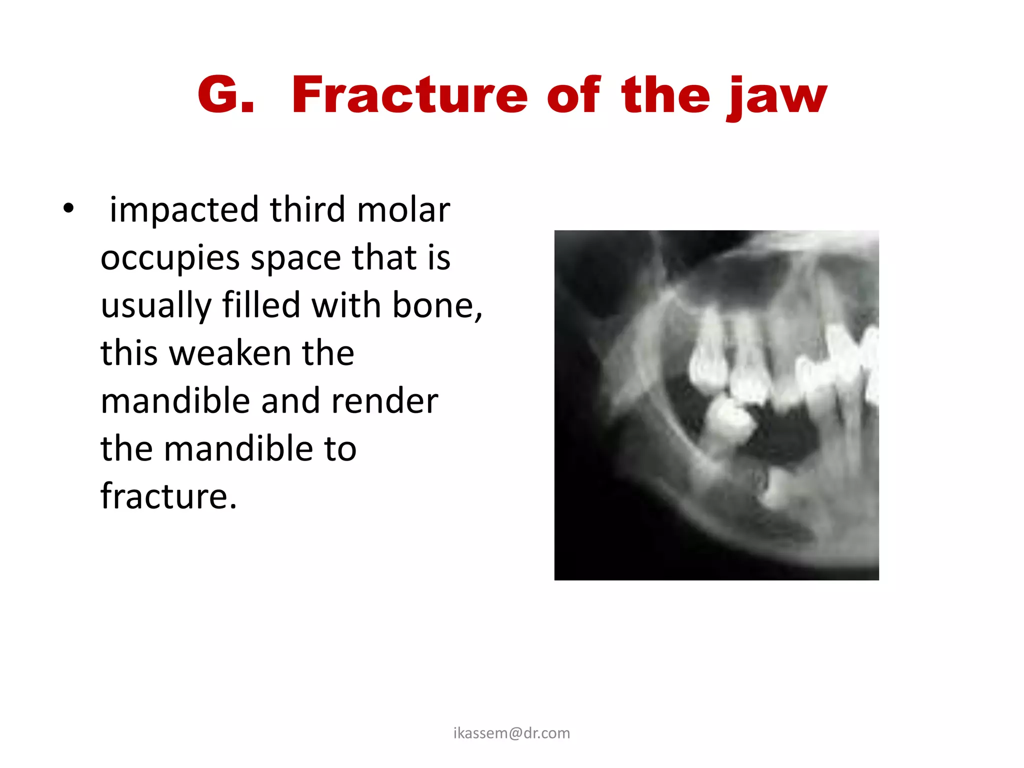 G. Fracture of the jaw

• impacted third molar
  occupies space that is
  usually filled with bone,
  this weaken the
  mandible and render
  the mandible to
  fracture.




                         ikassem@dr.com
 