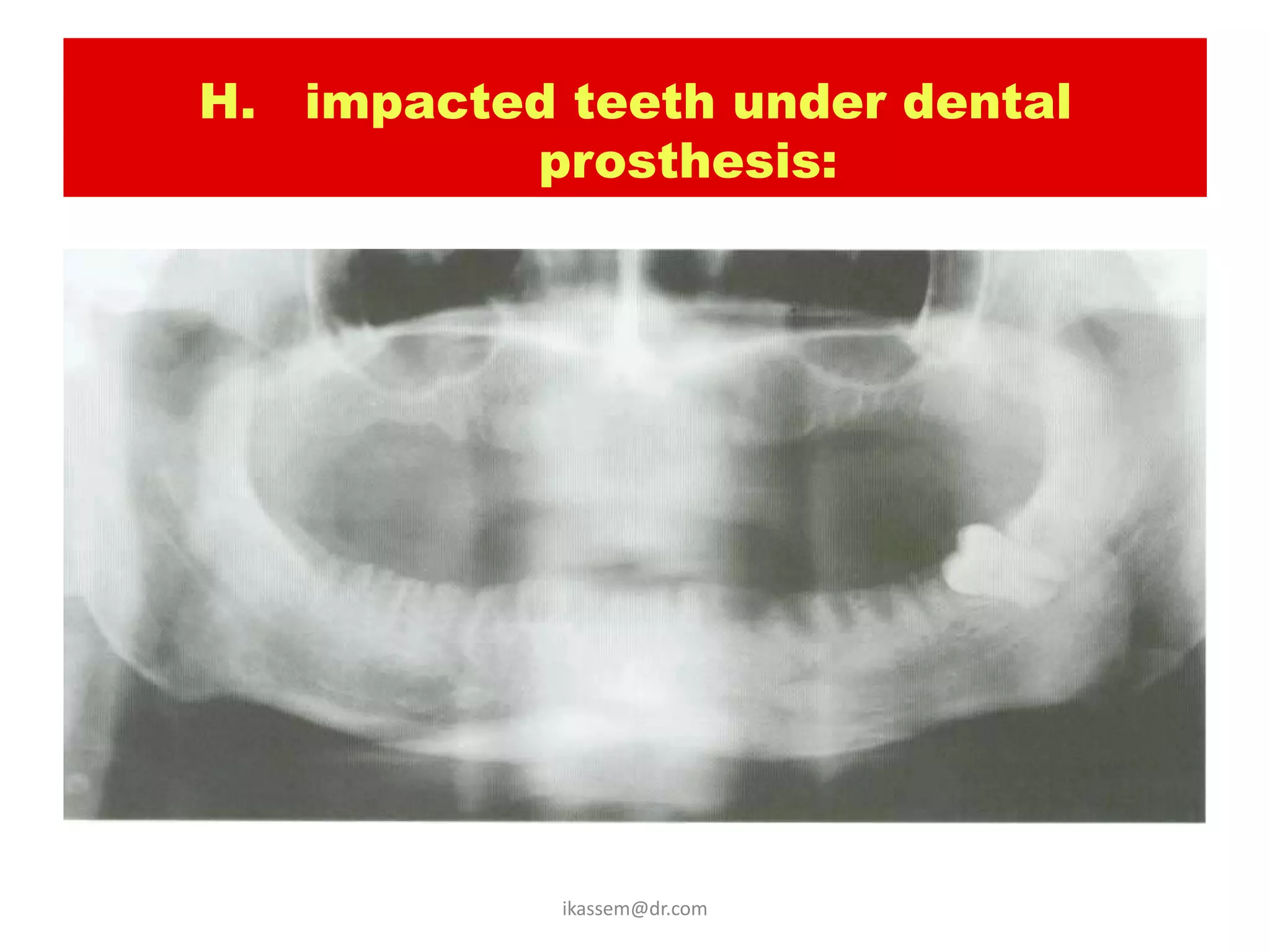 H. impacted teeth under dental
          prosthesis:




            ikassem@dr.com
 