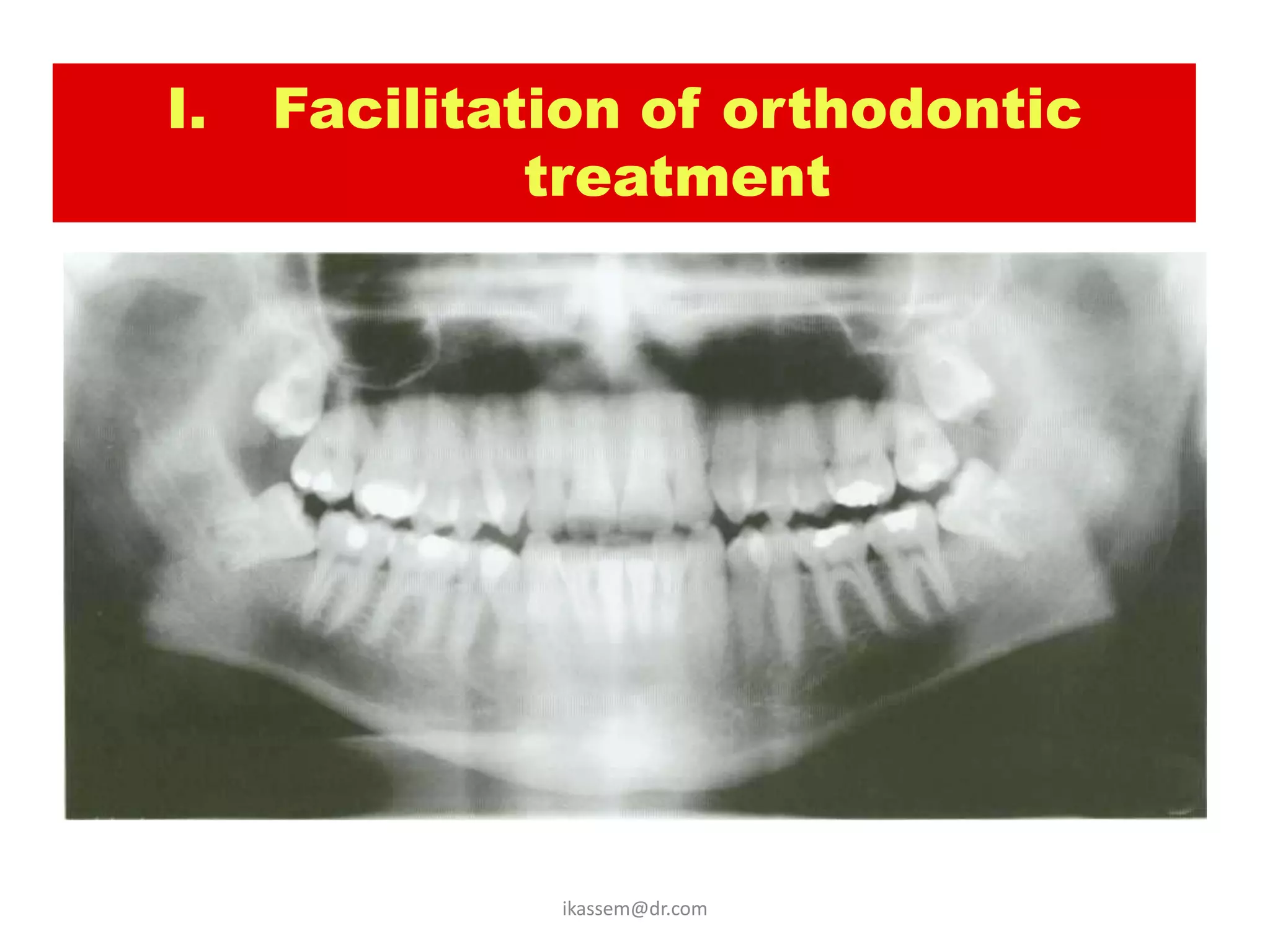 I.   Facilitation of orthodontic
                  treatment




• to relief crowding of
  mandibular anterior
  teeth.



                     ikassem@dr.com
 