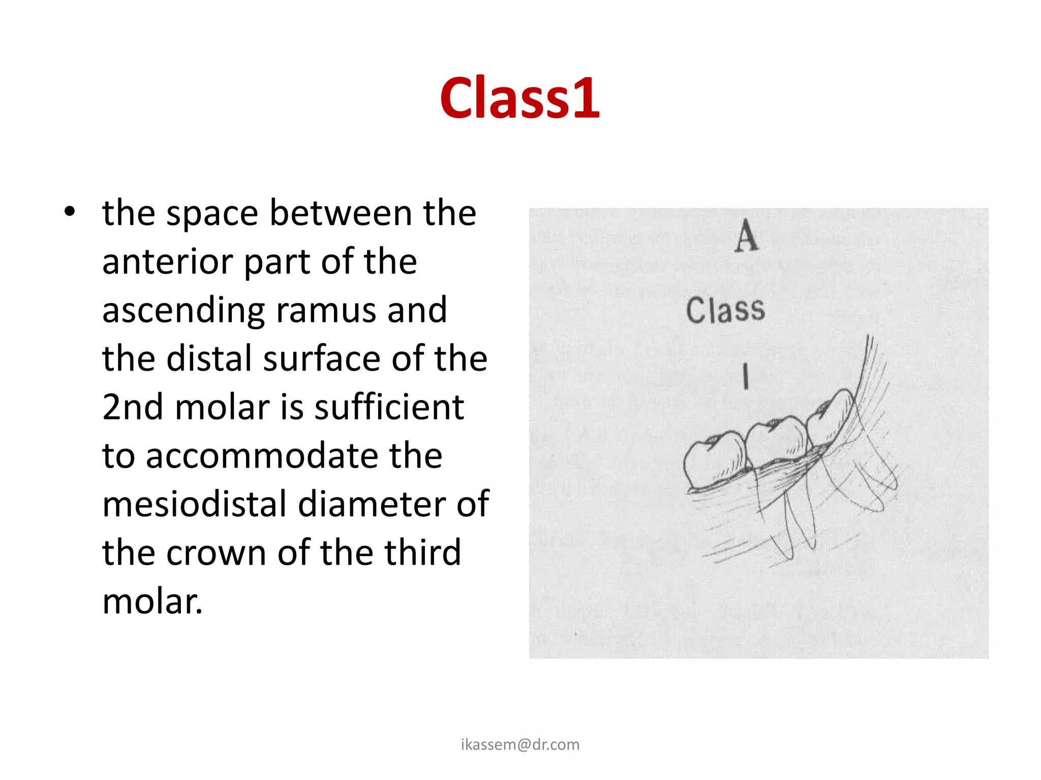 Class1
• the space between the
  anterior part of the
  ascending ramus and
  the distal surface of the
  2nd molar is sufficient
  to accommodate the
  mesiodistal diameter of
  the crown of the third
  molar.


                         ikassem@dr.com
 