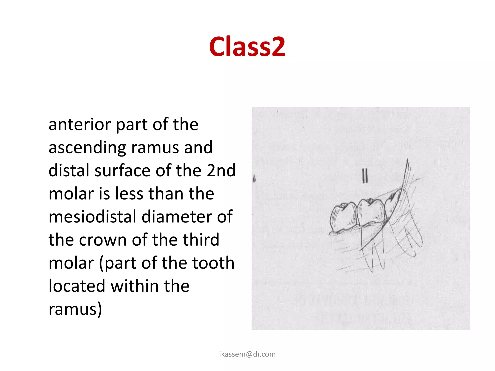 Class2
• the space between the
  anterior part of the
  ascending ramus and
  distal surface of the 2nd
  molar is less than the
  mesiodistal diameter of
  the crown of the third
  molar (part of the tooth
  located within the
  ramus)

                        ikassem@dr.com
 
