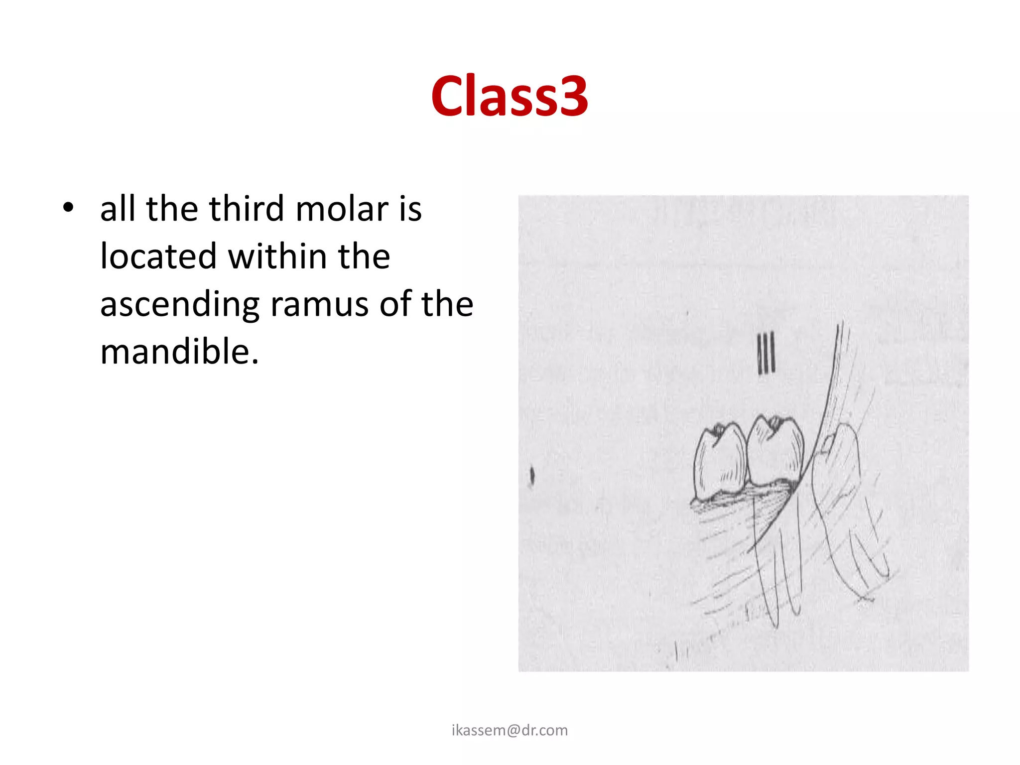 Class3
• all the third molar is
  located within the
  ascending ramus of the
  mandible.




                      ikassem@dr.com
 