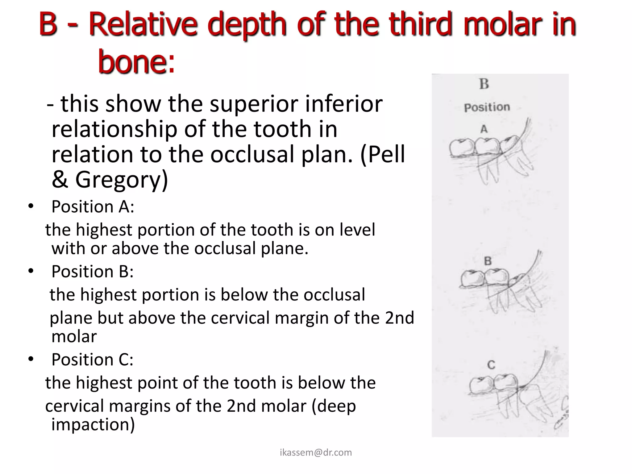 B - Relative depth of the third molar in
     bone:
  - this show the superior inferior
   relationship of the tooth in
   relation to the occlusal plan. (Pell
   & Gregory)
• Position A:
  the highest portion of the tooth is on level
   with or above the occlusal plane.
• Position B:
   the highest portion is below the occlusal
   plane but above the cervical margin of the 2nd
   molar
• Position C:
  the highest point of the tooth is below the
  cervical margins of the 2nd molar (deep
   impaction)
                               ikassem@dr.com
 