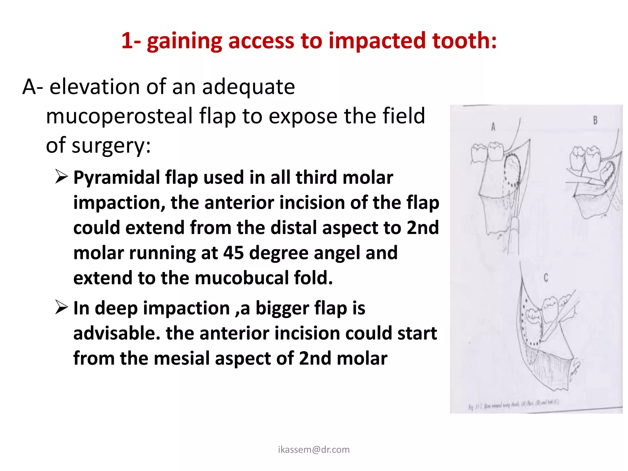 1- gaining access to impacted tooth:
A- elevation of an adequate
  mucoperosteal flap to expose the field
  of surgery:
    Pyramidal flap used in all third molar
     impaction, the anterior incision of the flap
     could extend from the distal aspect to 2nd
     molar running at 45 degree angel and
     extend to the mucobucal fold.
    In deep impaction ,a bigger flap is
     advisable. the anterior incision could start
     from the mesial aspect of 2nd molar



                             ikassem@dr.com
 