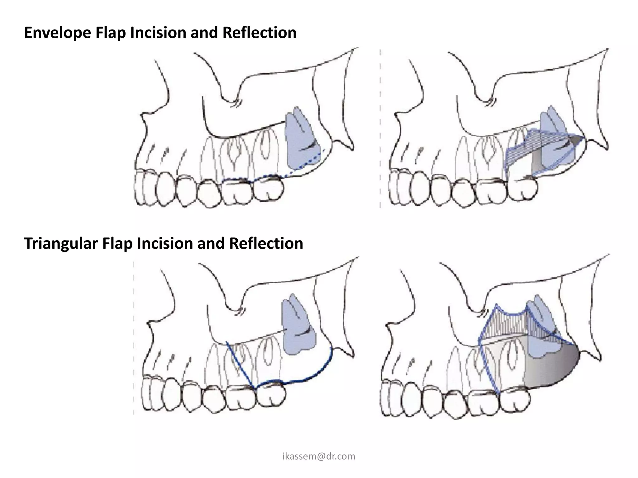 Envelope Flap Incision and Reflection




Triangular Flap Incision and Reflection




                                    ikassem@dr.com
 