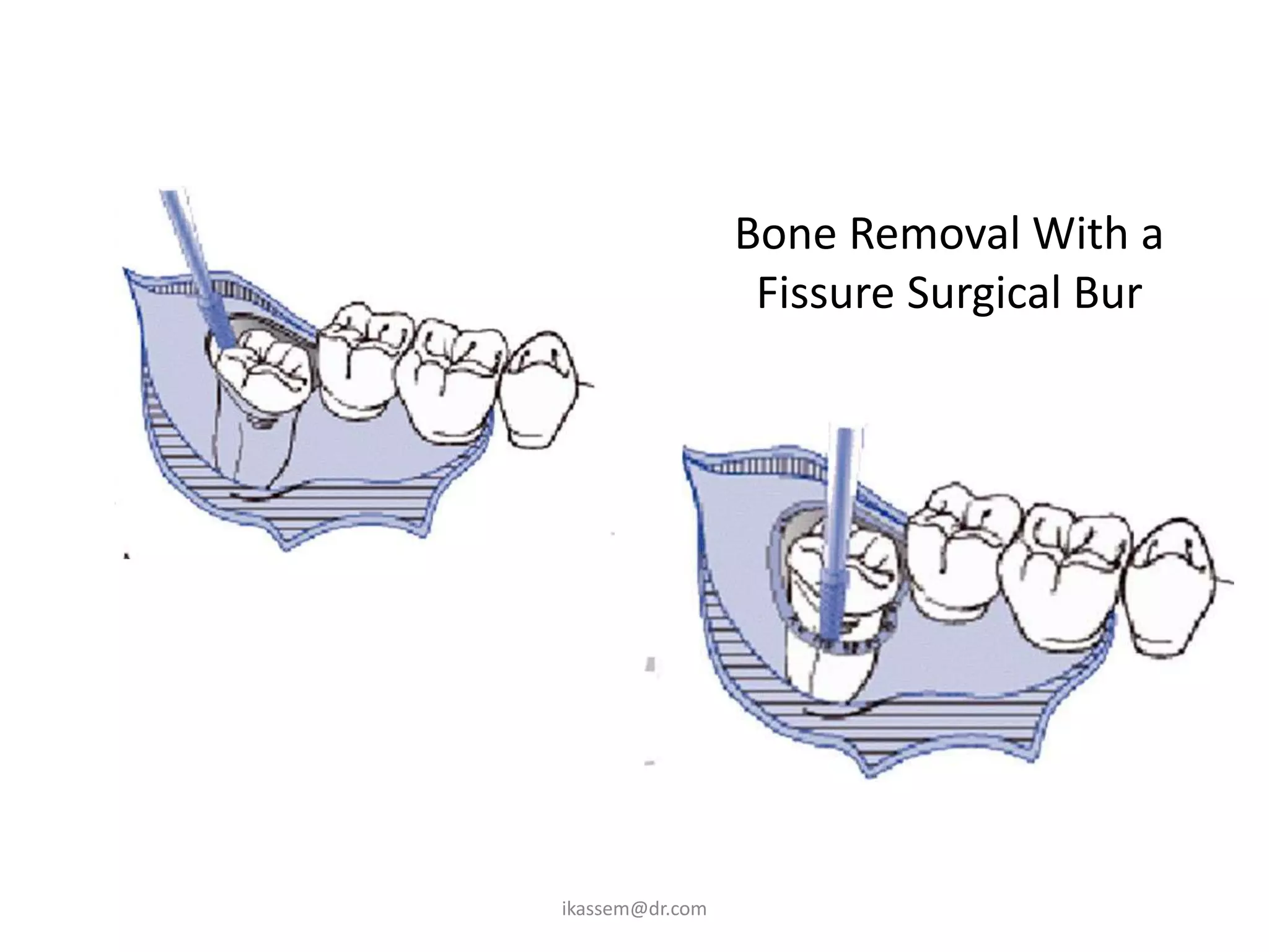 Bone Removal With a
                  Fissure Surgical Bur




ikassem@dr.com
 