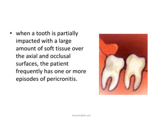 • when a tooth is partially
  impacted with a large
  amount of soft tissue over
  the axial and occlusal
  surfaces, the patient
  frequently has one or more
  episodes of pericronitis.




                      ikassem@dr.com
 