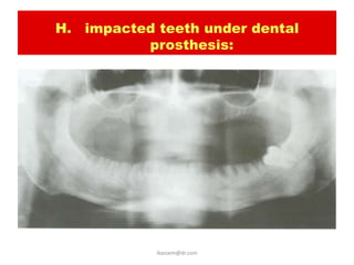 H. impacted teeth under dental
          prosthesis:




            ikassem@dr.com
 