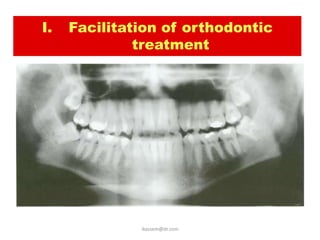 I.   Facilitation of orthodontic
                  treatment




• to relief crowding of
  mandibular anterior
  teeth.



                     ikassem@dr.com
 