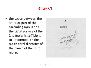 Class1
• the space between the
  anterior part of the
  ascending ramus and
  the distal surface of the
  2nd molar is sufficient
  to accommodate the
  mesiodistal diameter of
  the crown of the third
  molar.


                         ikassem@dr.com
 