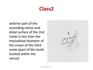 Class2
• the space between the
  anterior part of the
  ascending ramus and
  distal surface of the 2nd
  molar is less than the
  mesiodistal diameter of
  the crown of the third
  molar (part of the tooth
  located within the
  ramus)

                        ikassem@dr.com
 