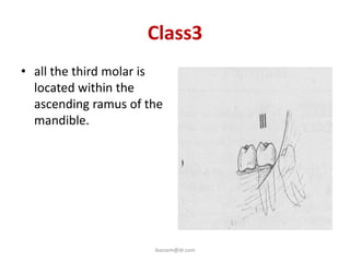 Class3
• all the third molar is
  located within the
  ascending ramus of the
  mandible.




                      ikassem@dr.com
 