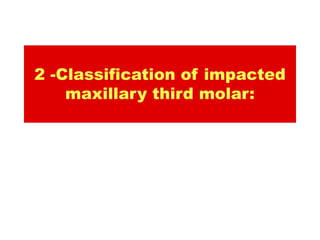 2 -Classification of impacted
    maxillary third molar:
 