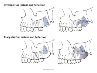 Envelope Flap Incision and Reflection




Triangular Flap Incision and Reflection




                                    ikassem@dr.com
 