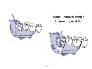 Bone Removal With a
                  Fissure Surgical Bur




ikassem@dr.com
 
