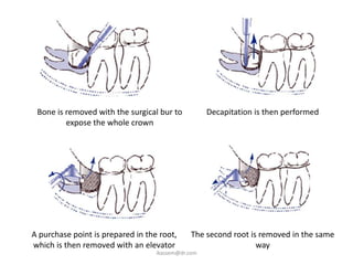 Bone is removed with the surgical bur to           Decapitation is then performed
         expose the whole crown




A purchase point is prepared in the root,     The second root is removed in the same
which is then removed with an elevator                          way
                                   ikassem@dr.com
 