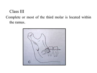 Management of Impacted third molars | PPTX