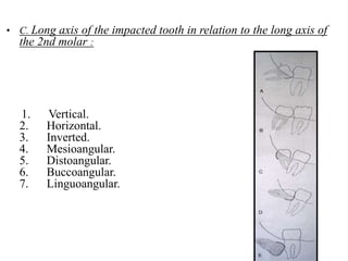 Management of Impacted third molars | PPTX