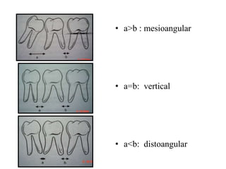 Management of Impacted third molars | PPTX