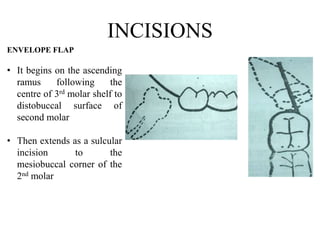 Management of Impacted third molars | PPTX