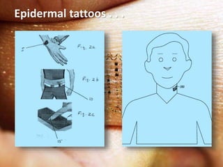 Epidermal tattoos . . .