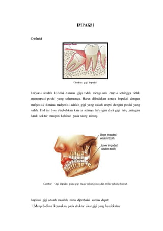 IMPAKSI
Definisi
Gambar: gigi impaksi
Impaksi adalah kondisi dimana gigi tidak mengalami erupsi sehingga tidak
menempati posisi yang seharusnya. Harus dibedakan antara impaksi dengan
malposisi, dimana malposisi adalah gigi yang sudah erupsi dengan posisi yang
salah. Hal ini bisa disebabkan karena adanya halangan dari gigi lain, jaringan
lunak sekitar, maupun kelainan pada tulang rahang.
Gambar : Gigi impaksi pada gigi molar rahang atas dan molar rahang bawah
Impaksi gigi adalah masalah harus diperbaiki karena dapat:
1. Menyebabkan kerusakan pada struktur akar gigi yang berdekatan.
 