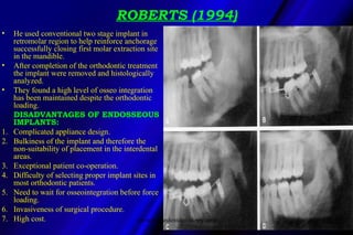 ROBERTS (1994)
• He used conventional two stage implant in
retromolar region to help reinforce anchorage
successfully clos...