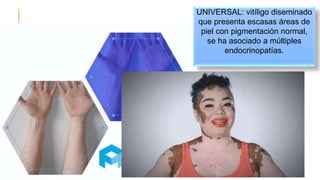 10
UNIVERSAL: vitíligo diseminado
que presenta escasas áreas de
piel con pigmentación normal,
se ha asociado a múltiples
endocrinopatías.
 