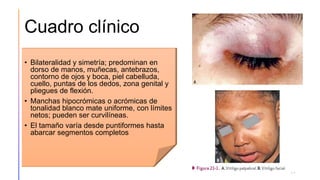 Cuadro clínico
• Bilateralidad y simetría; predominan en
dorso de manos, muñecas, antebrazos,
contorno de ojos y boca, piel cabelluda,
cuello, puntas de los dedos, zona genital y
pliegues de flexión.
• Manchas hipocrómicas o acrómicas de
tonalidad blanco mate uniforme, con límites
netos; pueden ser curvilíneas.
• El tamaño varía desde puntiformes hasta
abarcar segmentos completos
11
 