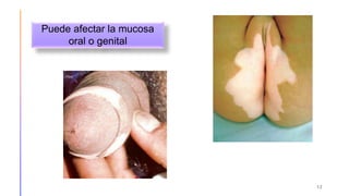 12
Puede afectar la mucosa
oral o genital
 