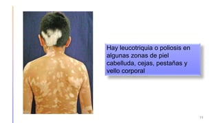 13
Hay leucotriquia o poliosis en
algunas zonas de piel
cabelluda, cejas, pestañas y
vello corporal
 