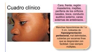 Cuadro clínico
Cara, frente, región
maseterina, mejillas,
periferia de los orificios
nasales, boca, conducto
auditivo externo, caras
externas de antebrazos.
21
Manchas hipocrómicas de 1 a
5 cm, rodeadas de
hiperpigmentación
perilesional, mal delimitadas,
cubiertas por escamas finas
que se desprenden con
facilidad. Casi siempre
múltiples.
 