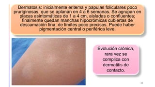 Dermatosis: inicialmente eritema y papulas foliculares poco
pruriginosas, que se aplanan en 4 a 6 semanas. Se agrupan en
placas asintomáticas de 1 a 4 cm, aisladas o confluentes;
finalmente quedan manchas hipocrómicas cubiertas de
descamación fina, de límites poco precisos. Puede haber
pigmentación central o periférica leve.
26
Evolución crónica,
rara vez se
complica con
dermatitis de
contacto.
 