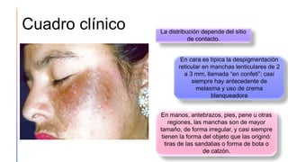 Cuadro clínico
32
La distribución depende del sitio
de contacto.
En cara es típica la despigmentación
reticular en manchas lenticulares de 2
a 3 mm, llamada “en confeti”; casi
siempre hay antecedente de
melasma y uso de crema
blanqueadora
En manos, antebrazos, pies, pene u otras
regiones, las manchas son de mayor
tamaño, de forma irregular, y casi siempre
tienen la forma del objeto que las originó:
tiras de las sandalias o forma de bota o
de calzón.
 