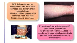 33
20% de los enfermos se
producen lesiones a distancia,
llamadas ides discromiantes
hidroquinónicas
(hidroquinónides); predominan
en manos y son manchas
hipocrómicas o acrómicas.
Evolución crónica y despigmentación
permanente, puede haber
repigmentación en años. A veces se
puede ver la etapa inicial caracterizada
por dermatitis aguda con eritema y
descamación.
 