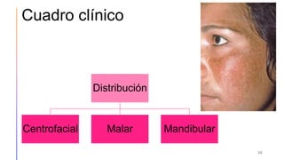 Cuadro clínico
Distribución
Centrofacial Malar Mandibular
39
 